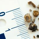 Причины появления фосфатных камней в почках и их лечение Как вывести фосфаты из почек